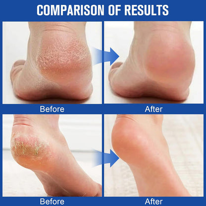 Barubt Urea Hand and Foot Cream Moisturizing Heel Protection Stick